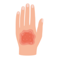 Eine Hand mit einer rötlichen, unebenen Hautstelle.