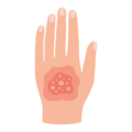 Eine Hand mit einer rötlichen, knötchenartigen Hautveränderung.