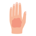 Eine menschliche Hand mit einer rötlichen, unregelmäßigen Hautstelle in der Mitte.